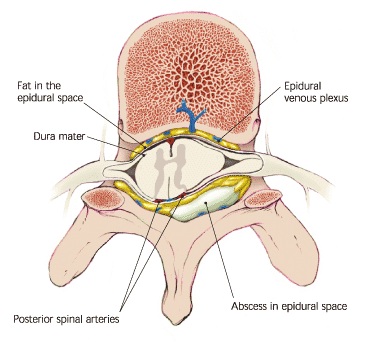 epidural-abscess epidural-abscess